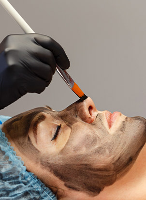 Laser-Carbon-Peel-service