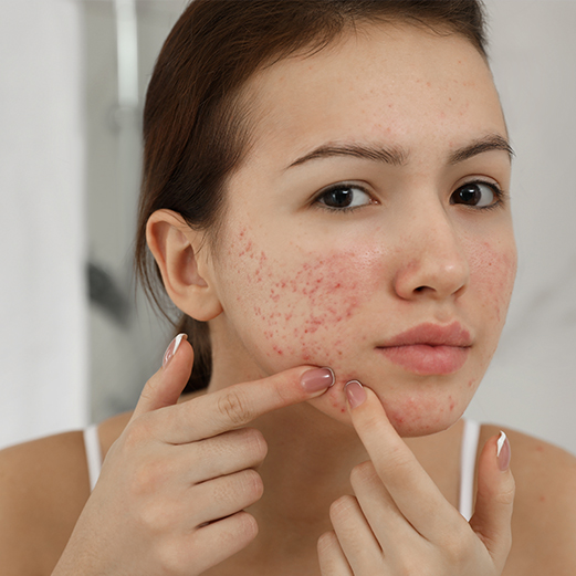 acne scars