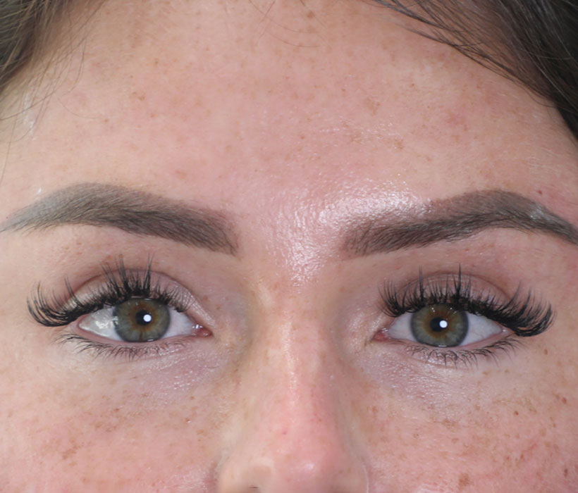Eyebrow-lift-after