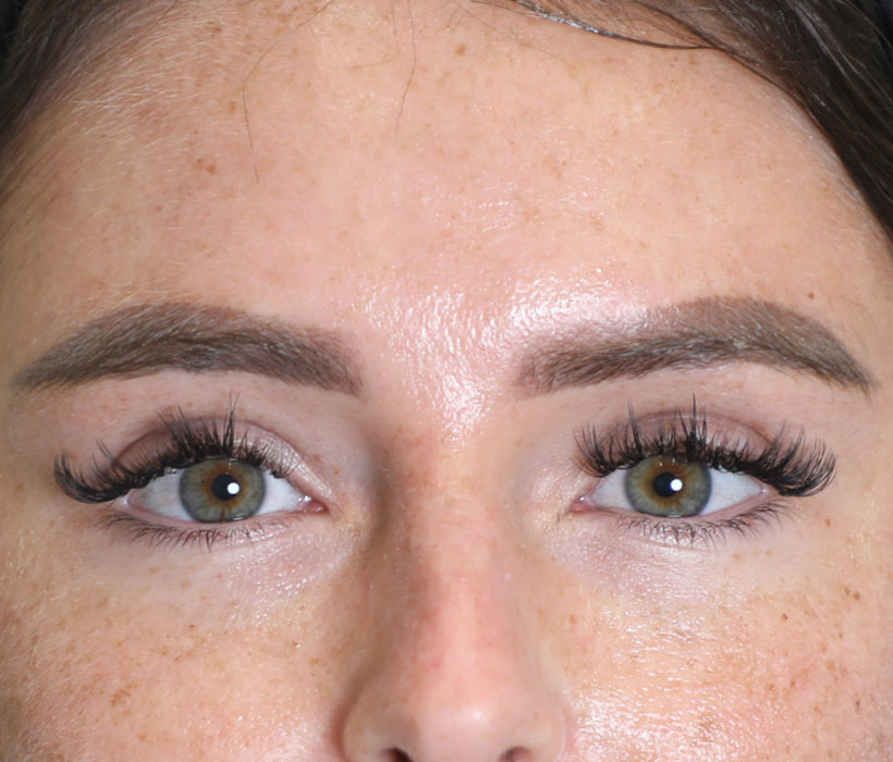 Eyebrow-lift-before