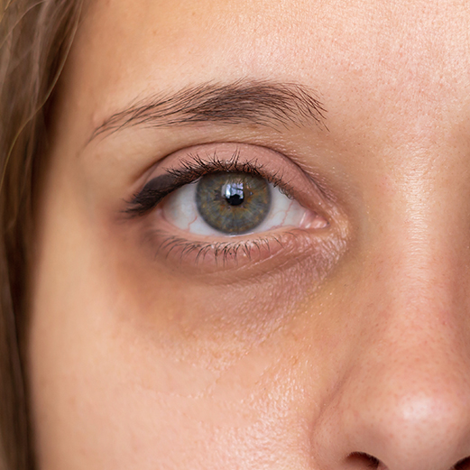 under eye treatment dubai